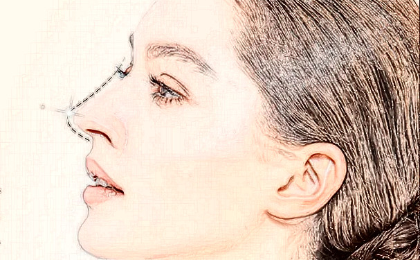 武漢碧蓮盛醫(yī)療美容門診部頭發(fā)種植術(shù)后三個(gè)月經(jīng)典案例(效果怎么樣?技術(shù)評(píng)價(jià))