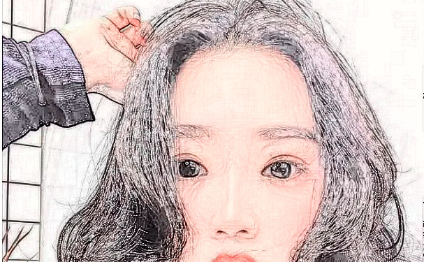 哈爾濱紫曦醫(yī)療美容門診部植發(fā)技術怎么樣?三個月案例恢復過程