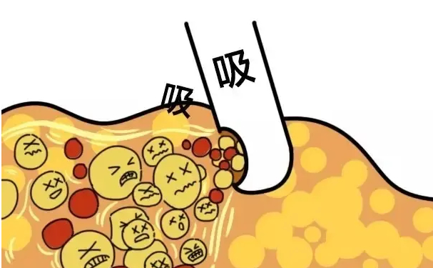 北京貴美匯醫(yī)院脂肪填充報價多少?技術(shù)優(yōu)點怎么樣?