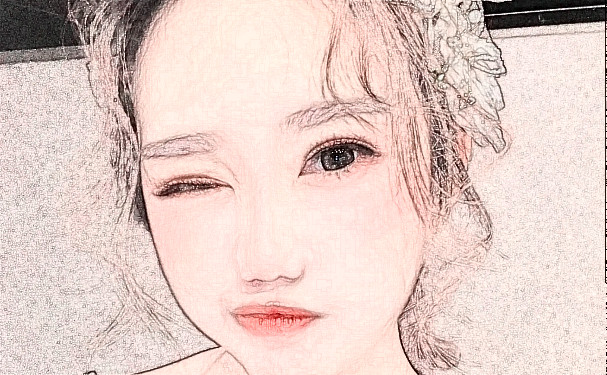 西南醫(yī)科大學附屬醫(yī)院玻尿酸去黑眼圈怎么樣?多少錢?術(shù)后120天案例&技術(shù)風格