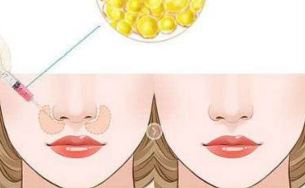 宜昌市中心人民醫(yī)院膠原蛋白填充鼻唇溝醫(yī)生排名,費用明細(xì)?心動案例