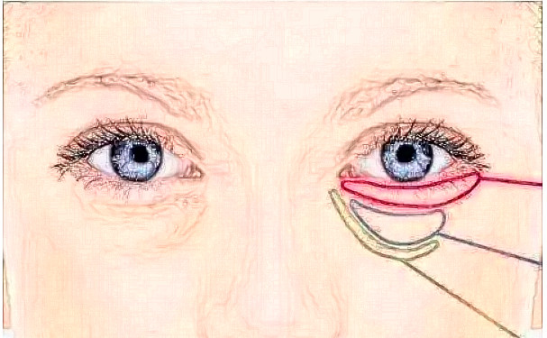 上海中山醫(yī)院做眼袋恢復案例&技術怎么樣?